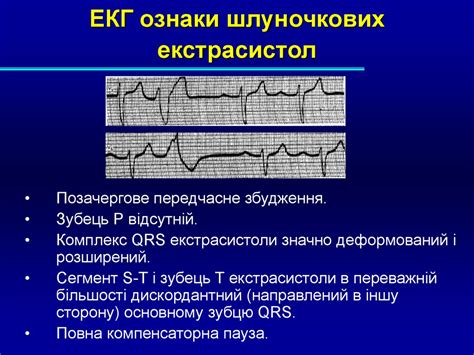 Клінічні та ЕКГ-ознаки порушень збудливості та провідності ...