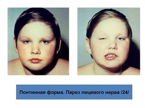 Полиомиелит. Этиология - online presentation