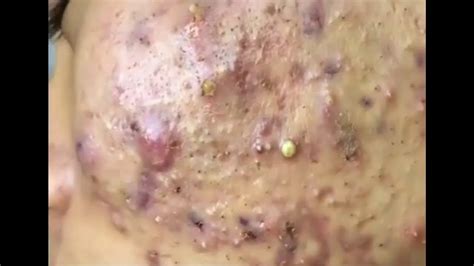 Unbelievable Blackhead Removal 2024: Get Ready for Flawless Skin - ypxfja6