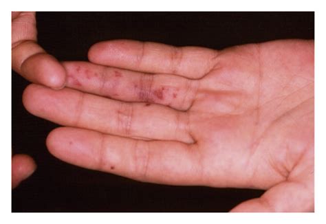 janeway lesions erythematous macular painless rashes distributed