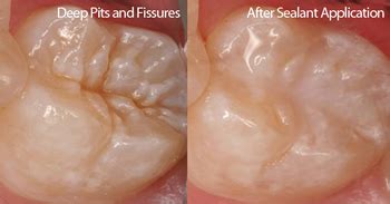 Pit and Fissure Sealant ~ Dr. Bharat Katarmal Dental & Implant Clinic