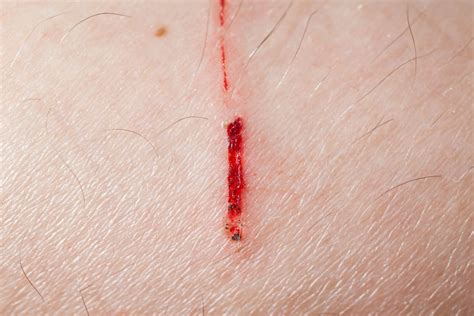 10 Causes of Staph Infection - Facty Health