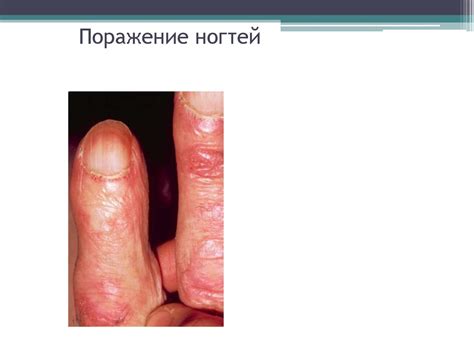 Дерматомиозит - презентация онлайн