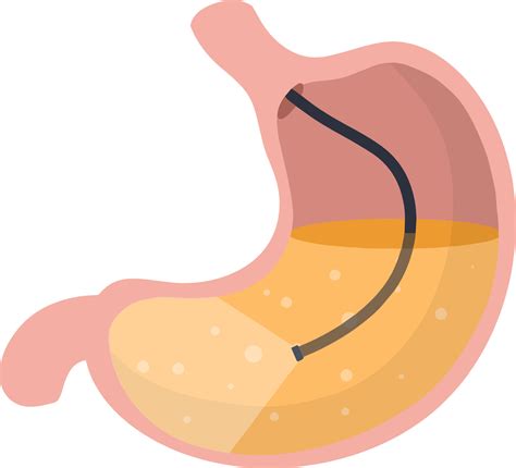 gastroscopy endoscopy  digestive problems hose  camera