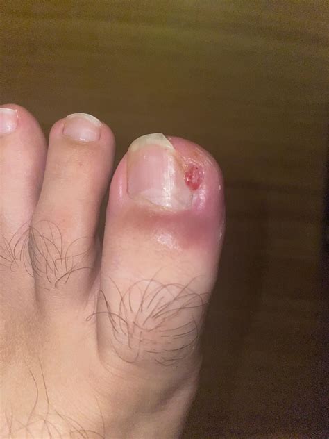 Is this normal one year after phenol matrixectomy? : r/Ingrown_Toenails