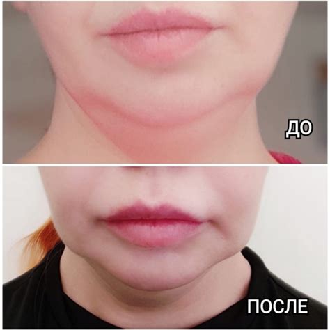 Уменьшение локальных жировых отложений в области подбородка и нижней ...