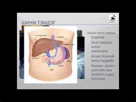 Цирроз - Элэгний хатуурал - YouTube