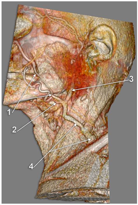Anatomical Variations of the External Jugular Vein: A Pictorial and