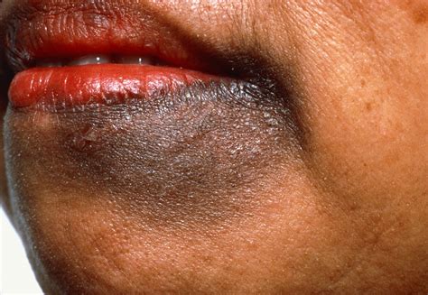 common skin conditions  people  color identification  treatment