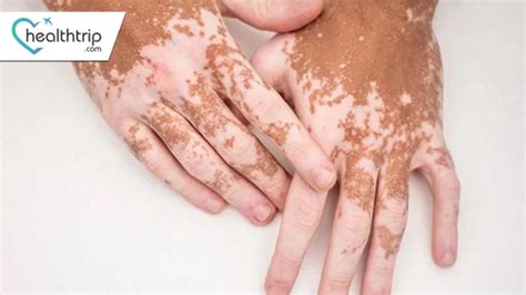 Comprehensive Guide to Vitiligo Treatment in India: Top Hospitals ...