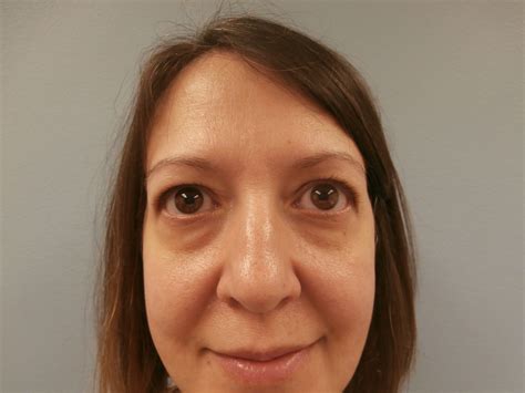 Eyelid Lift Before and After Photos Minneapolis, Minnesota
