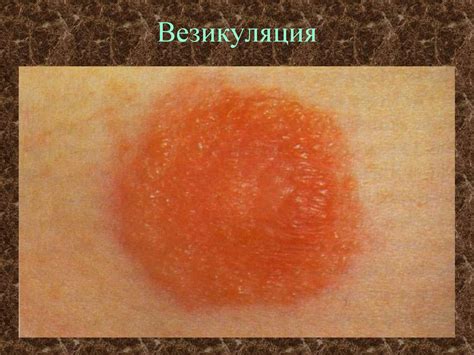 Морфологические элементы кожных сыпей - презентация онлайн