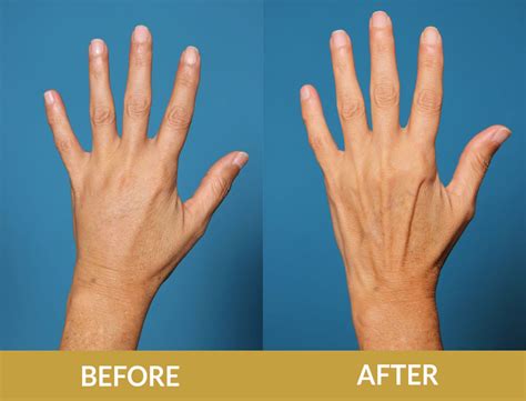 BEFORE & AFTER RADIESSE RESULTS