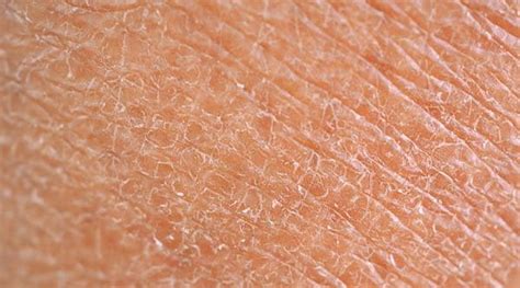 Dry Skin in Winters - Know Causes of Dry Skin In Winters