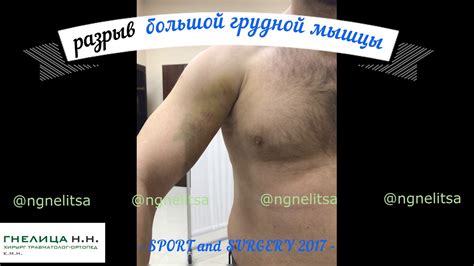 разрыв большой грудной мышцы - шов "свежего" разрыва этой мышцы (хирург ...