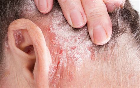 WHAT IS PSORIASIS?