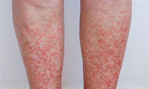 how to get rid of sun rash