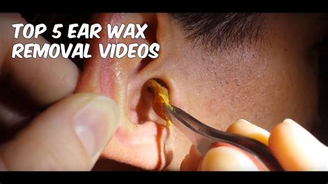 5 Awesome Tips to Remove Ear Wax - YouTube