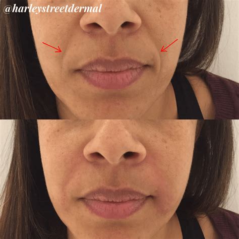 face exercise for smile lines 2