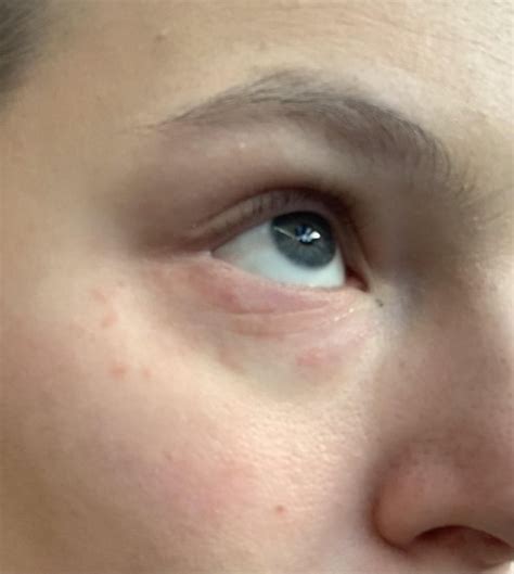Periorbital dermatitis : r/Perioral_Dermatitis_