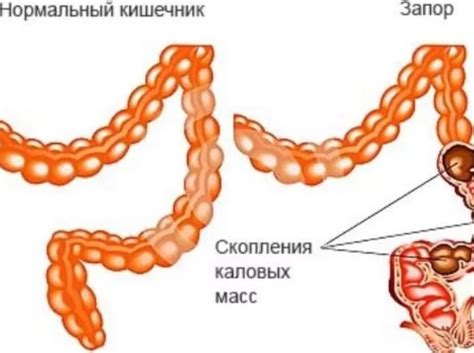 Запоры у взрослых: причины и лечение запоров - Чем лечить запор у взрослого