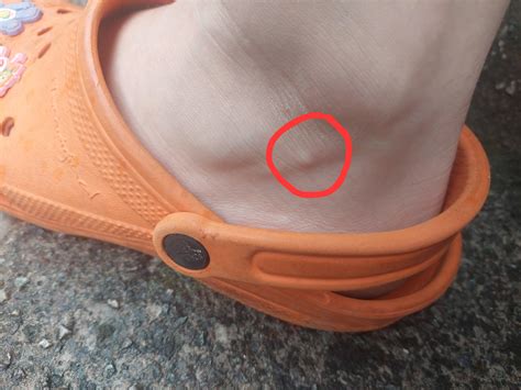 Weird bump on ankle : r/medical_advice