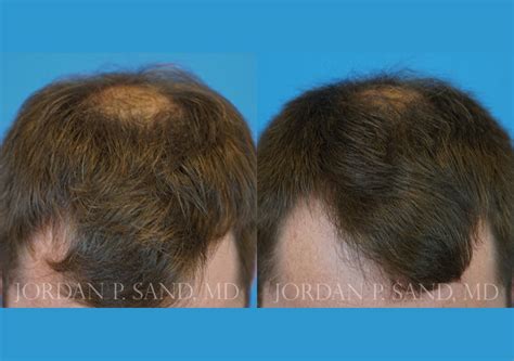 Prp to Scalp 1 - Sand Plastic Surgery of Spokane