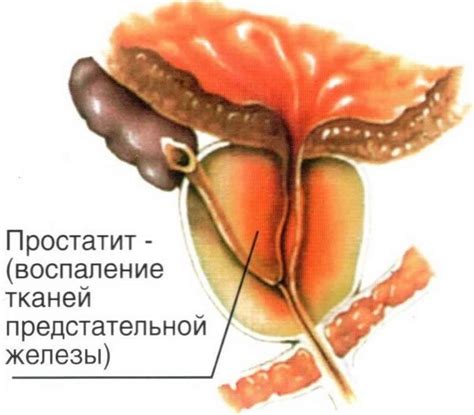Эхо-признаки хронического простатита на УЗИ.