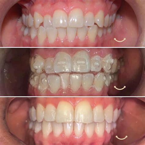 clear teeth aligners uk  matthew brunskill blog