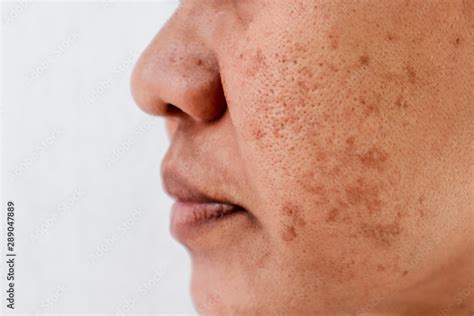 skin problem skin face asian women  spot melasma dark spots