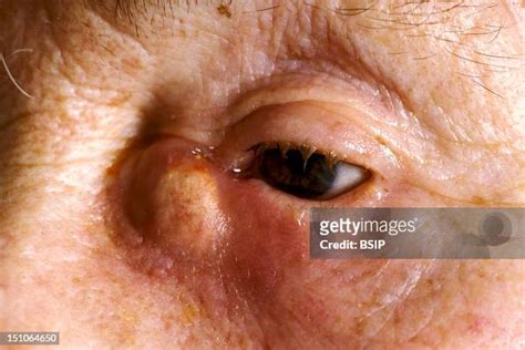 Dacryocystitis Photos and Premium High Res Pictures - Getty Images