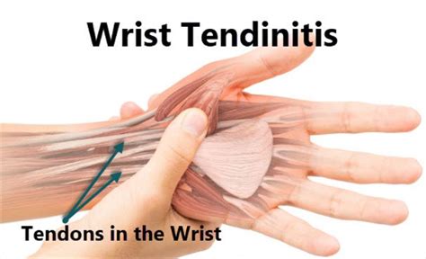 Wrist Tendonitis