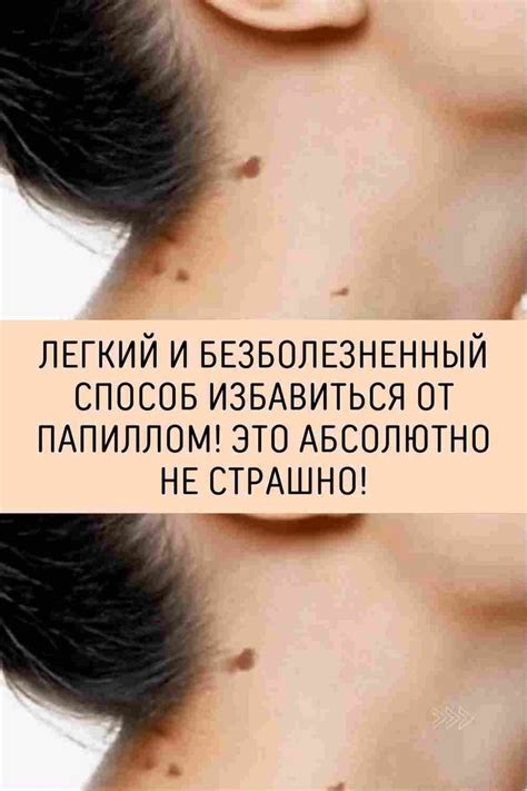 Легкий и безболезненный способ избавиться от папиллом! Это абсолютно не ...