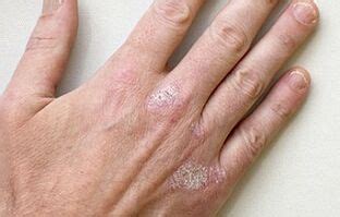 Psoriasis - Dr. DERM